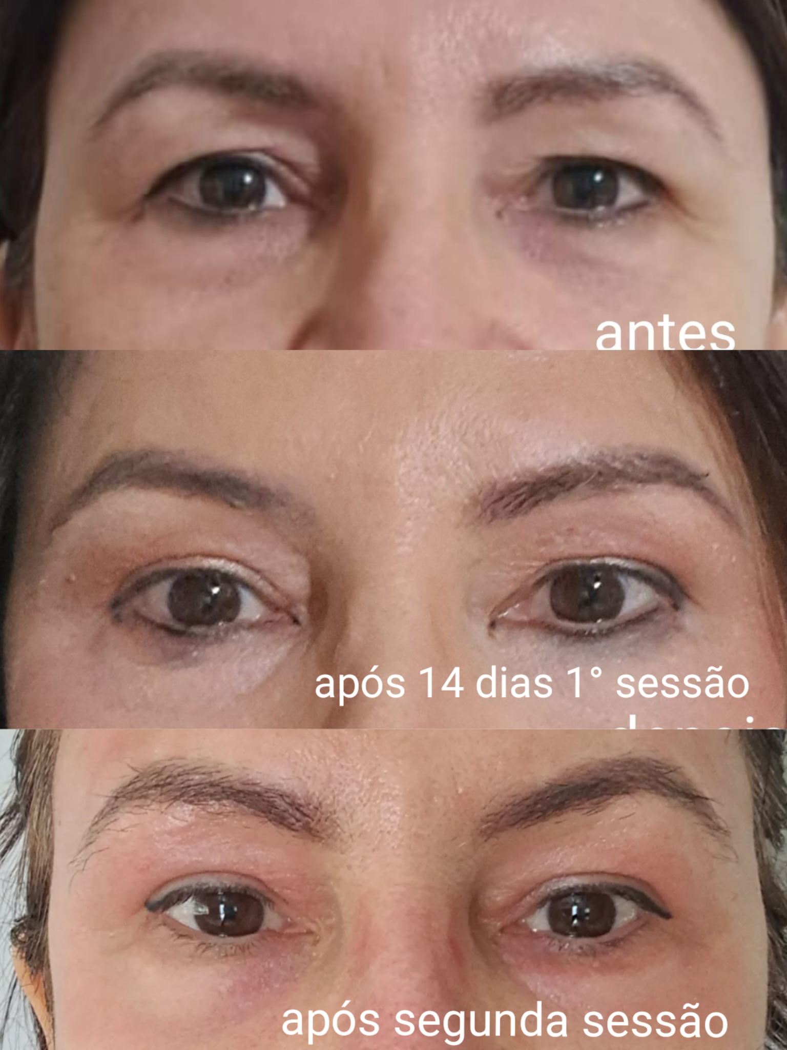 Antes e depois do NewSkin - Roseli Bender