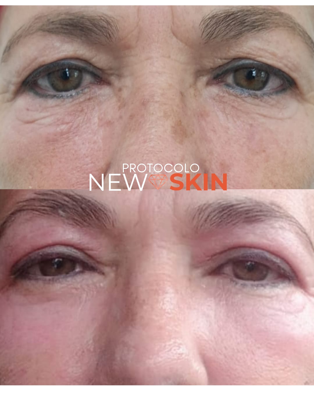 Antes e depois do NewSkin - Roseli Bender