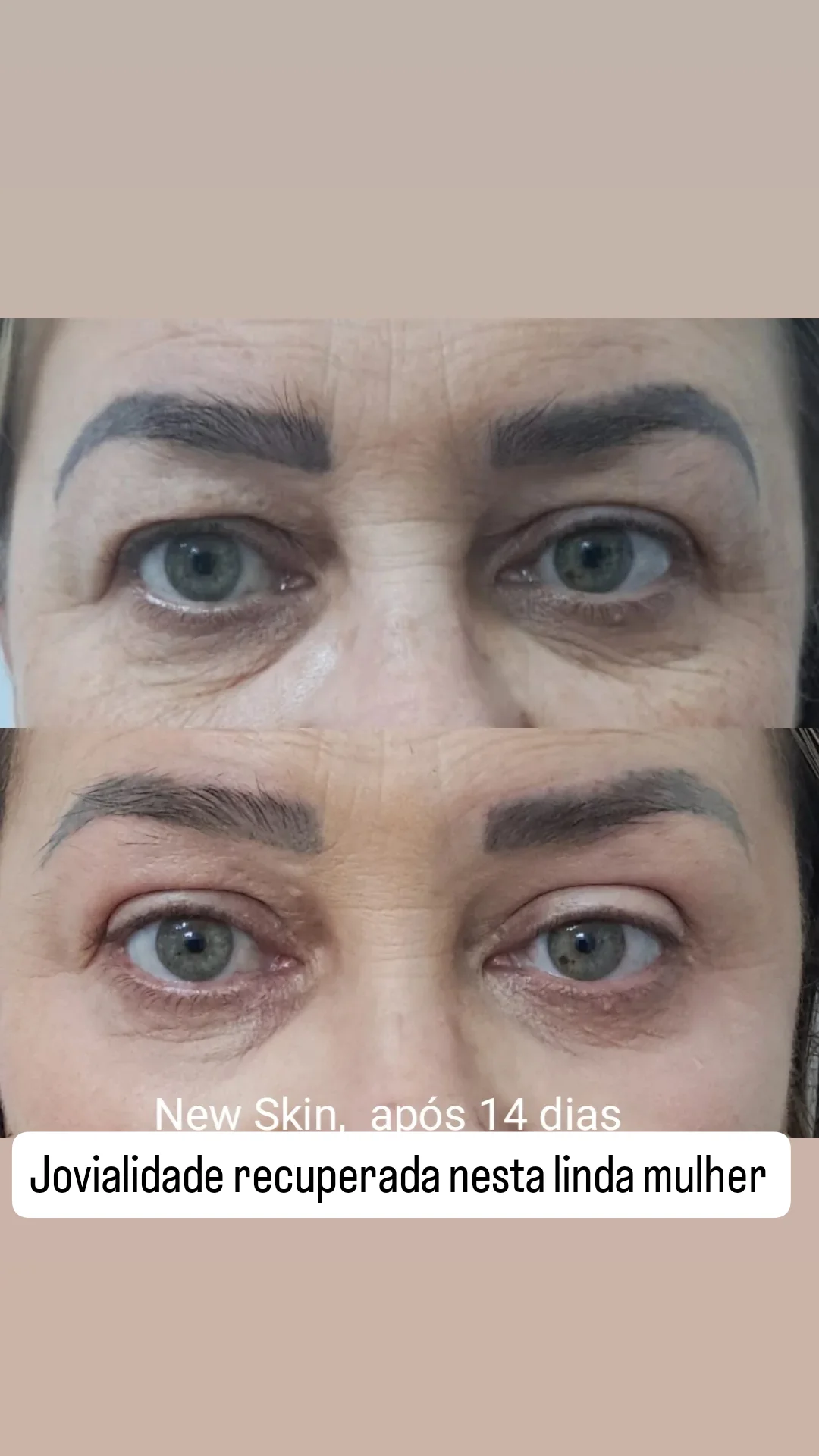 Antes e depois do NewSkin - Roseli Bender