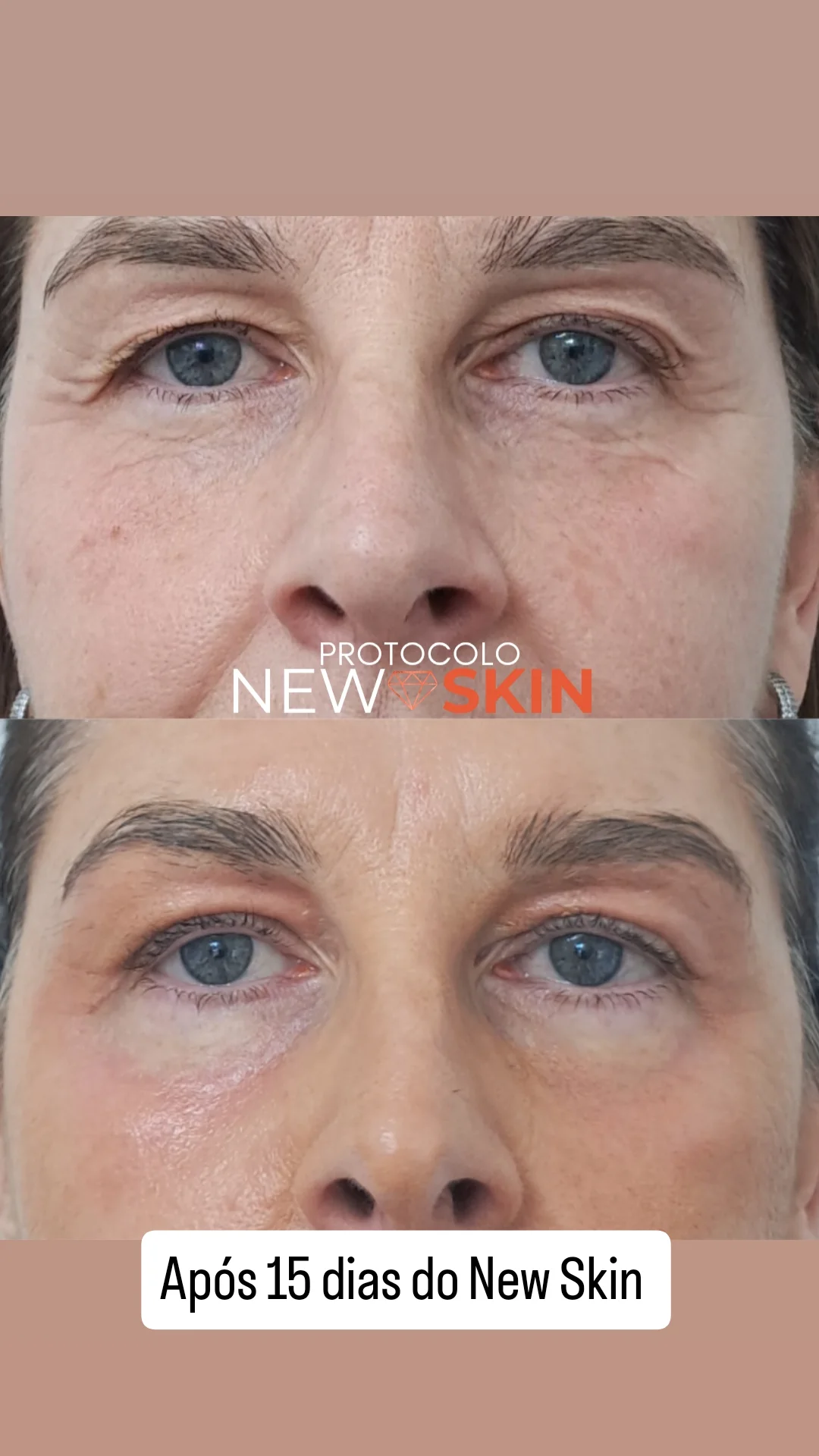 Antes e depois do NewSkin - Roseli Bender